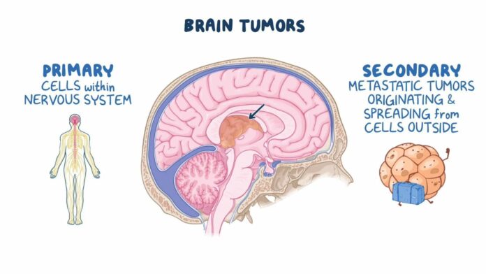brain tumors